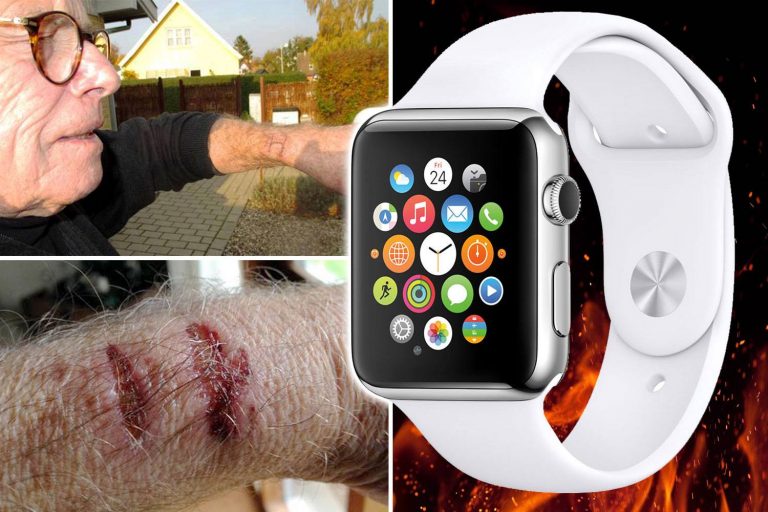 Apple Watch provoca ustione al polso di un danese